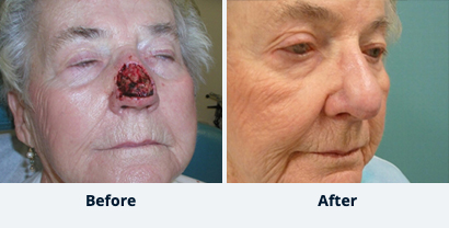 Before and After Reconstructive Surgery