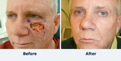 Before and After Reconstructive Surgery
