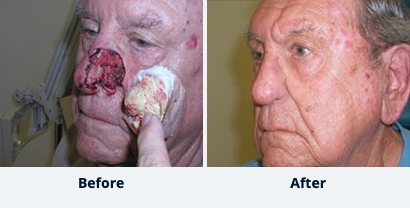 Before and After Reconstructive Surgery