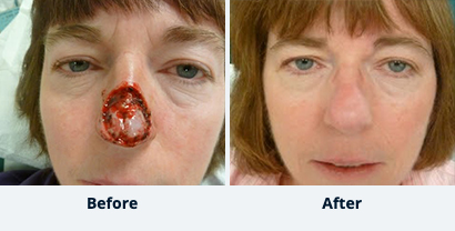 Before and After Reconstructive Surgery