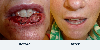 Before and After Reconstructive Surgery
