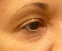 Eyelid Lift Before