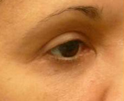 Eyelid Lift After