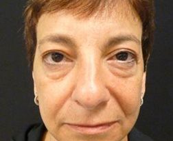 Before Eyelid Surgery Results