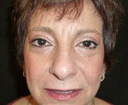 After Eyelid Surgery Results