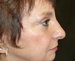 After Eyelid Surgery Results
