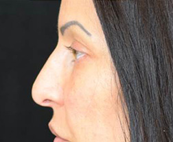 Eyelid Lift After