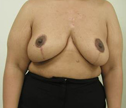 Breast Reduction After