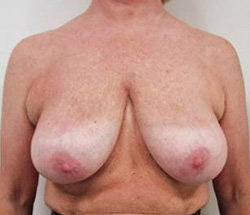 Before Breast Reduction Results