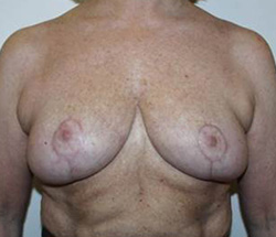 After Breast Reduction Results