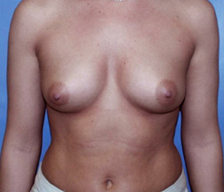 Breast Augmentation Before