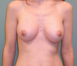 Breast Augmentation After