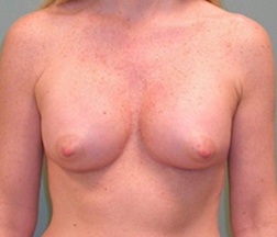 Breast Augmentation Before