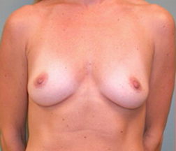 Breast Augmentation Before