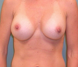 Breast Augmentation After