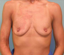 Breast Augmentation Before