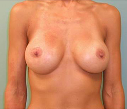 Breast Augmentation After