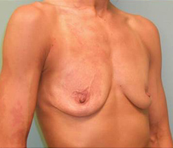 Before Surgical Breast Results