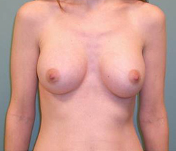 Breast Augmentation After