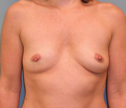 Breast Augmentation Before