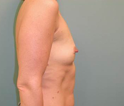 Breast Augmentation Before