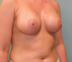 After Breast Augmentation Results