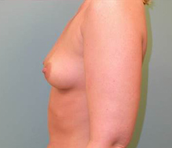 Breast Augmentation Before