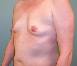 Breast Augmentation Before