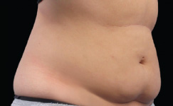 Before CoolSculpting® Results