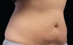 After CoolSculpting® Results