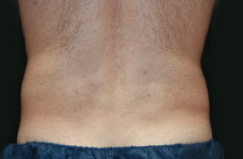 CoolSculpting™ After