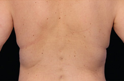 CoolSculpting™ After