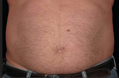 CoolSculpting™ Before