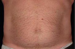 CoolSculpting™ After