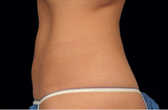 CoolSculpting™ After