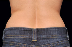 CoolSculpting™ After