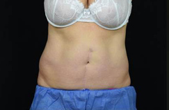 CoolSculpting™ Before