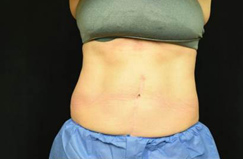 CoolSculpting™ After