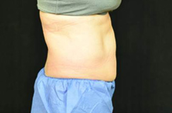 CoolSculpting™ After