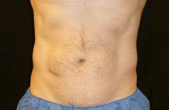 Before CoolSculpting® Results