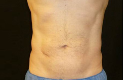 After CoolSculpting® Results