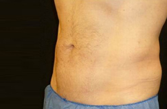 CoolSculpting™ After