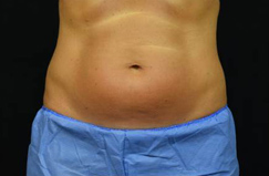 CoolSculpting™ Before