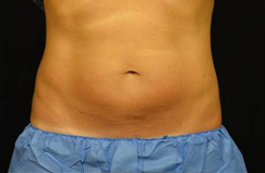 CoolSculpting™ After