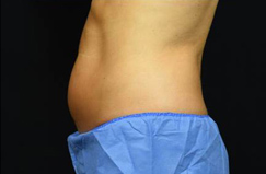 CoolSculpting™ Before