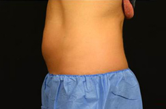 CoolSculpting™ After