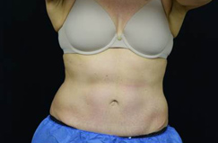 CoolSculpting™ After