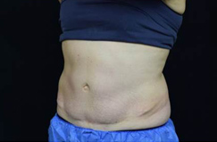 CoolSculpting™ Before