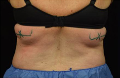 CoolSculpting™ Before