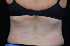 CoolSculpting™ After